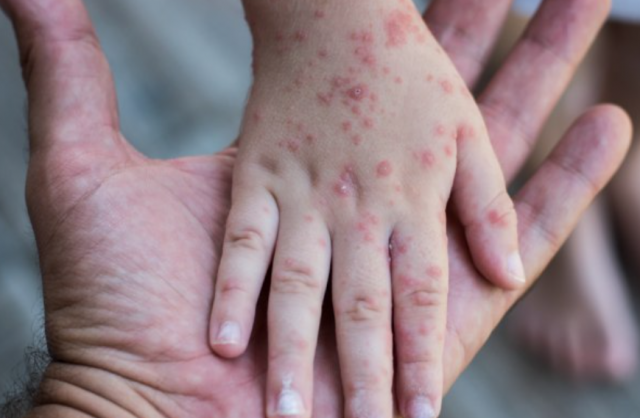 Koksaki virus ili morbile: Kako ih razlikovati?